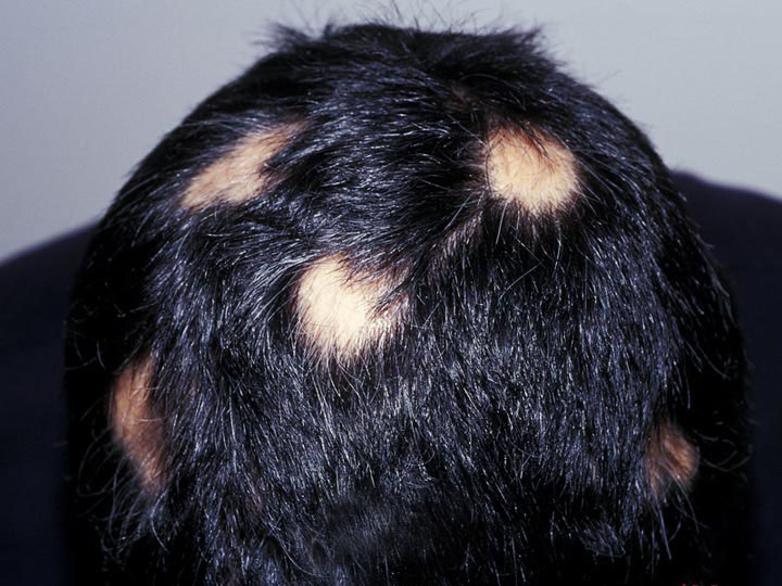 Common types of alopecia :: Various ... - Alopecia Totalis