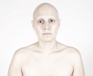 alopecia universal