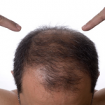 Cómo frenar la alopecia androgenética?