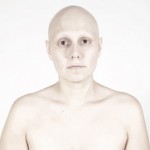 Alopecia Universal
