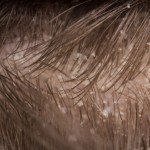 Enfermedades comunes en el cuero cabelludo