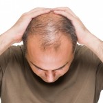 Aumento de la caída del cabello con la crisis