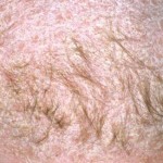 Tratar un eczema en el cuero cabelludo