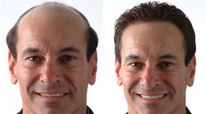 transplantes-de-cabello