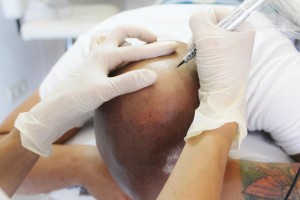 micropigmentacion-capilar